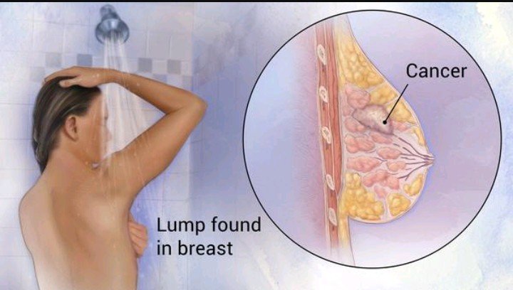 10 Best Natural Foods That Prevent Breast Cancer