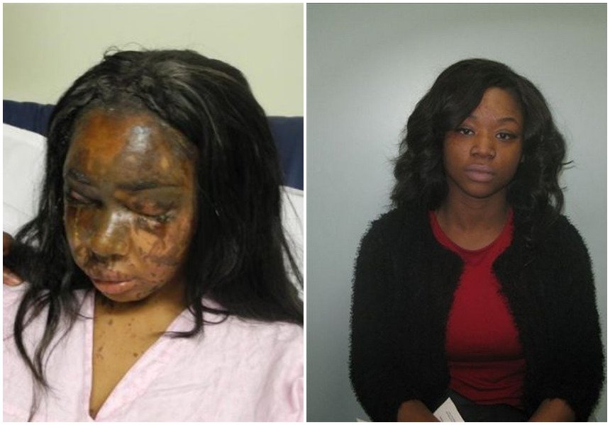25-year-old lady recounts how her best friend threw acid in her face then came to her birthday party