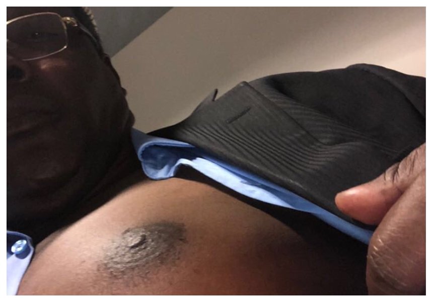 “I’m sick. My ribs and body is hurting” Miguna strips to show injuries he suffered after being beaten at the airport