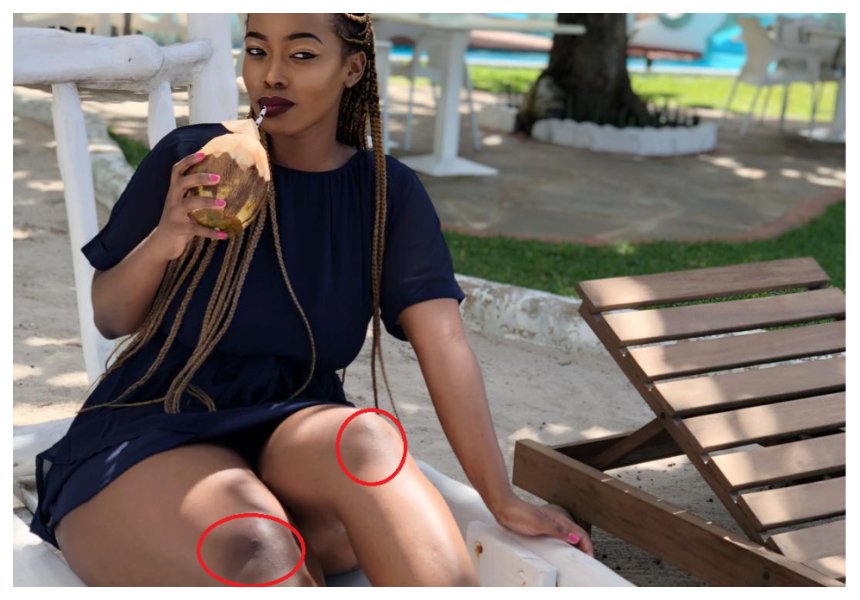 “I didn’t bleach” Corazon Kwamboka explains why her knees are black while the rest of her body is much lighter 