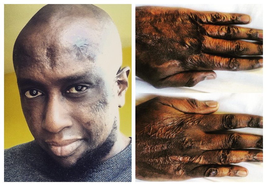 Former TPF pianist Aaron Rimbui talks about suffering burns from gas explosion and battle with heart disease and cancer 