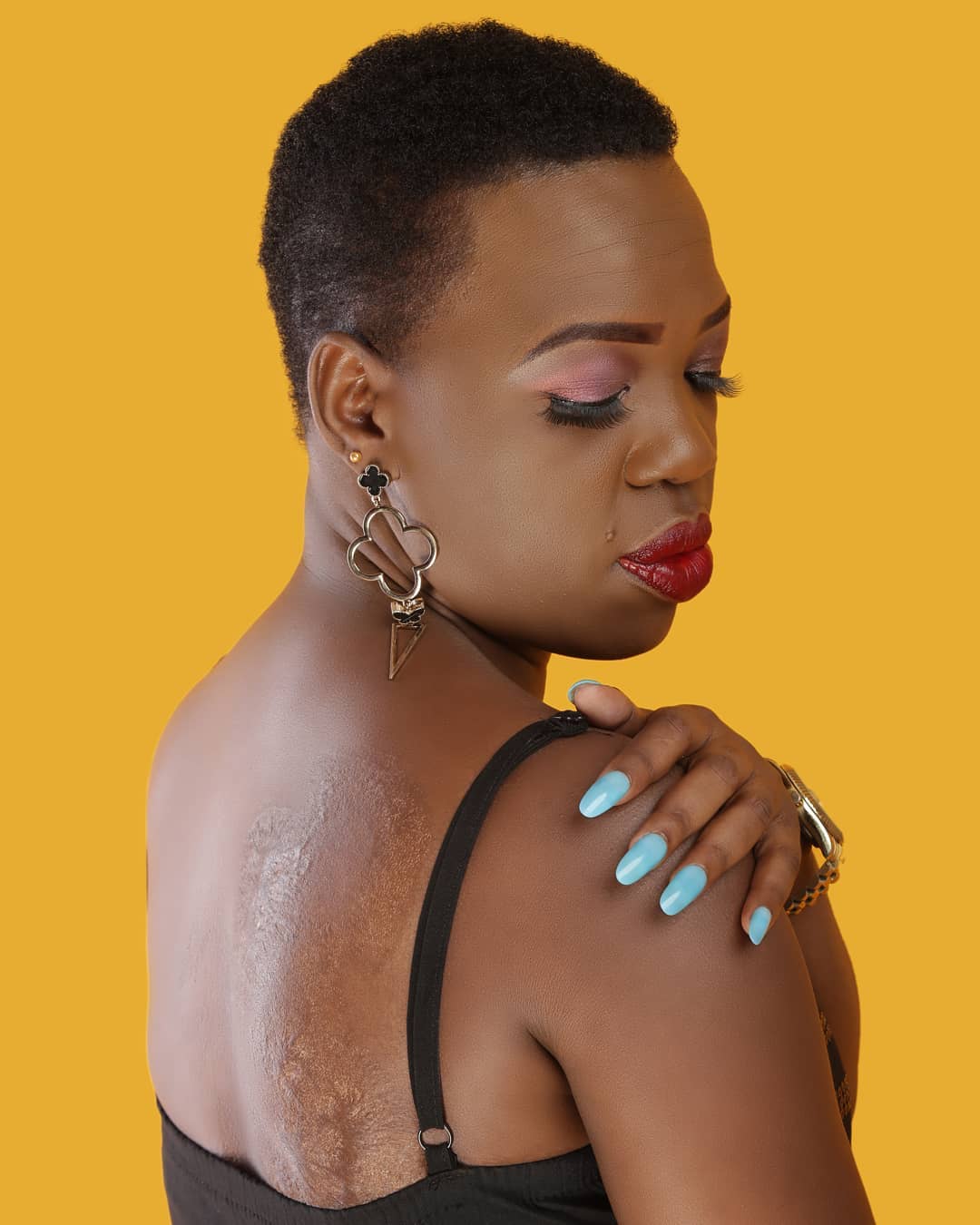 Ruth Matete explains why she has a scar on her back: I got burned by porridge