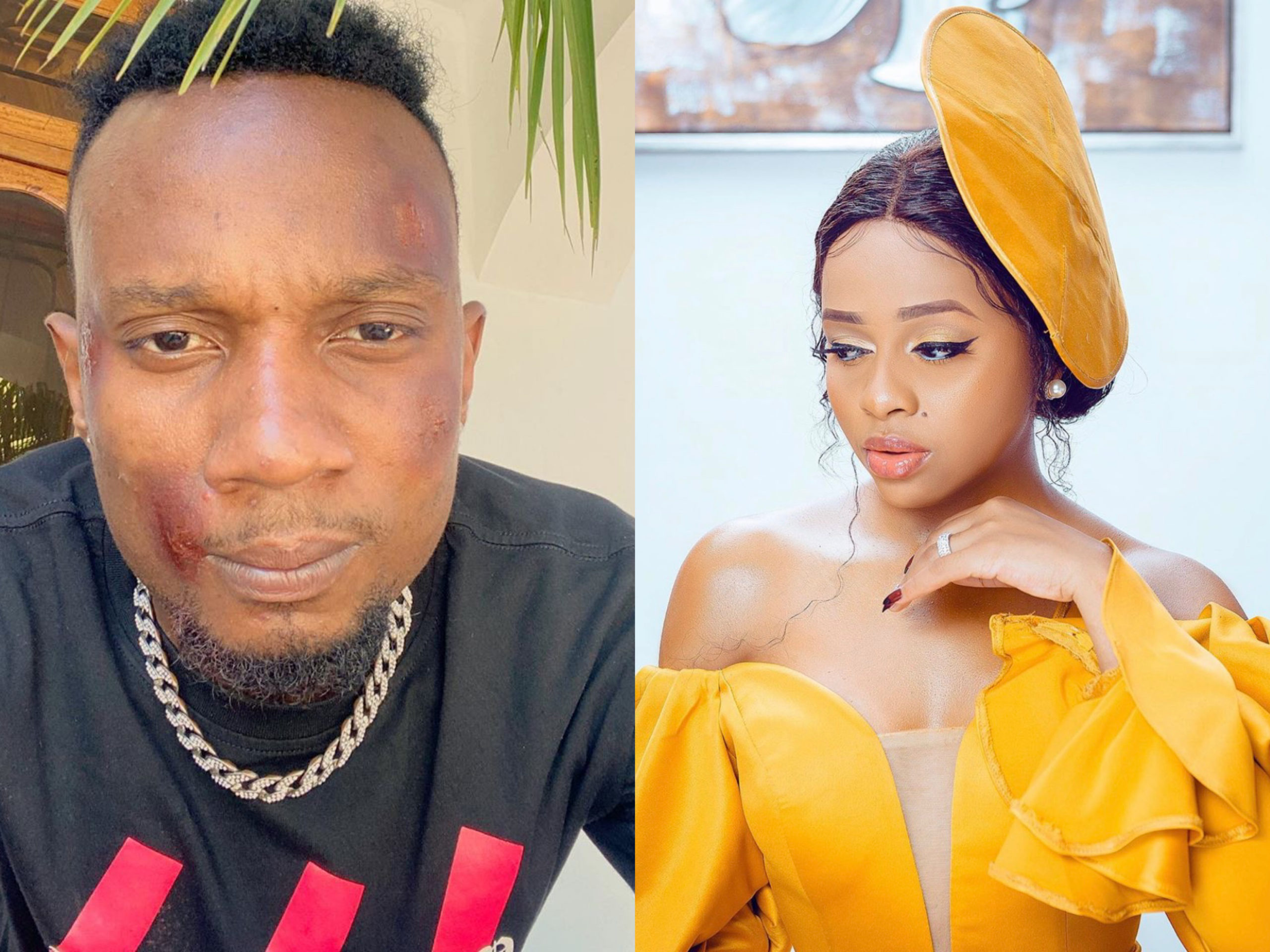 Nandy’s boyfriend beaten black and blue by unknown persons (Photo)
